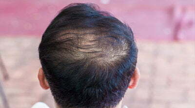 Causes and treatments for thinning hair 5