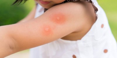What to understand approximately skeeter syndrome 2
