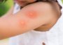 What to understand approximately skeeter syndrome 4