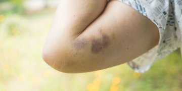 How to treatment bruises at domestic 13