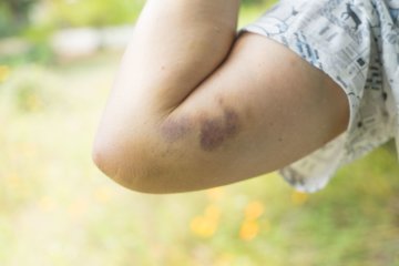 How to treatment bruises at domestic 3