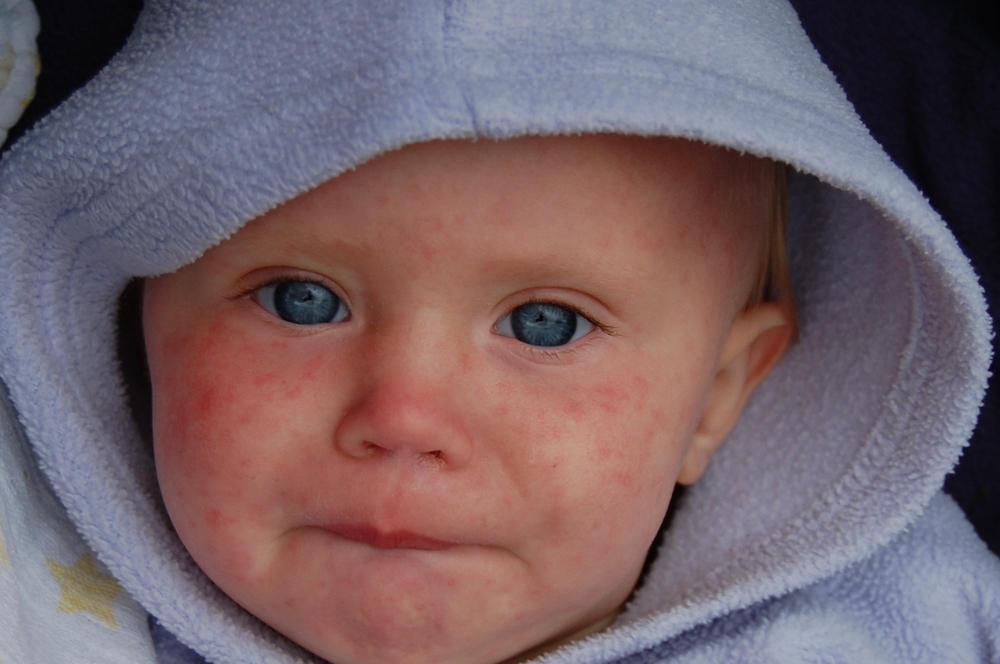 Measles Treatment: eight Home Remedies To Help You Recover 7