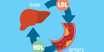 High Ldl Cholesterol - How to Treat It 1