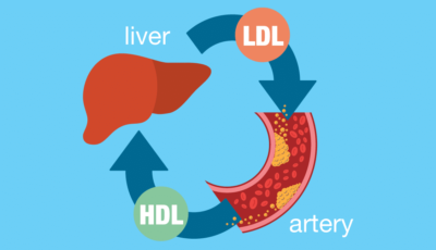 High Ldl Cholesterol - How to Treat It 21