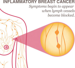 Unusual Breast Cancer Symptoms 6