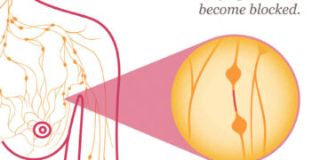 Unusual Breast Cancer Symptoms 17