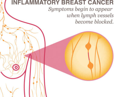 Unusual Breast Cancer Symptoms 8