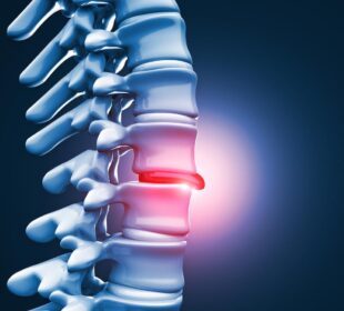L5 S1 Herniated Disc 5