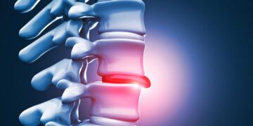 L5 S1 Herniated Disc 17