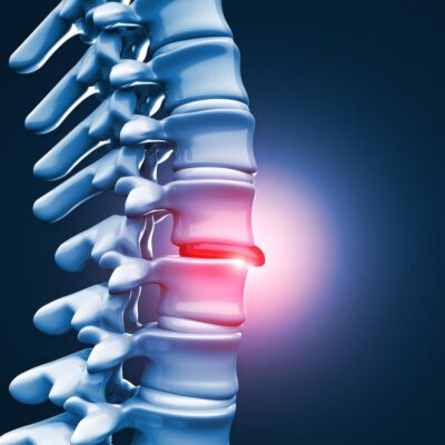 L5 S1 Herniated Disc 7