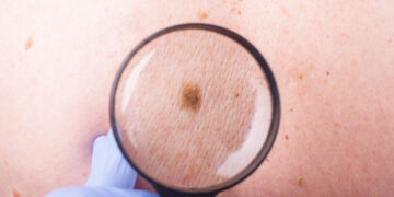 Signs and Symptoms of Skin Cancer  13