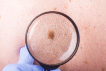 Signs and Symptoms of Skin Cancer  2