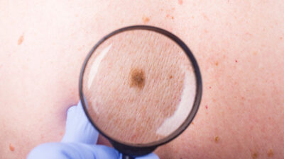 Signs and Symptoms of Skin Cancer  2