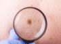 Signs and Symptoms of Skin Cancer  6